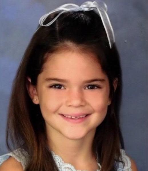 Kendall Jenner With Braces See Her Transformation And Stunning Results 