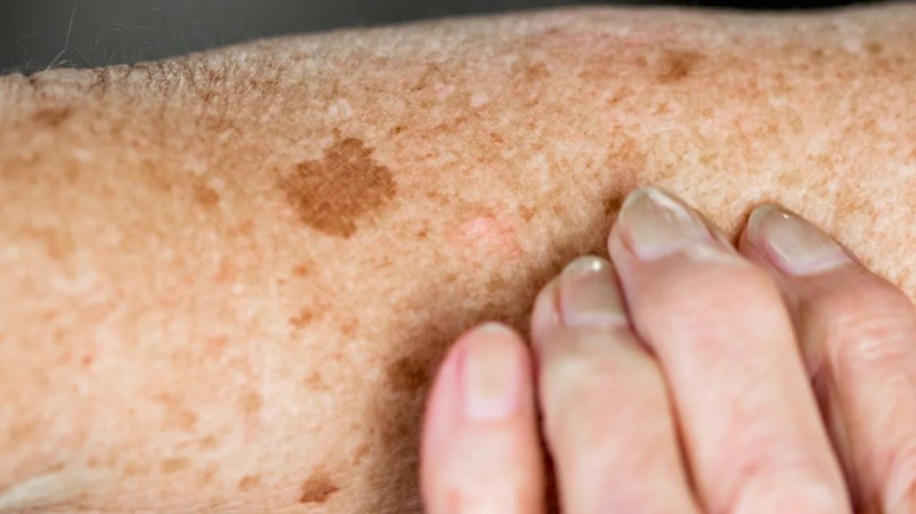 Can Age Spots Be Raised? Exploring The Truth Behind Skin Bumps