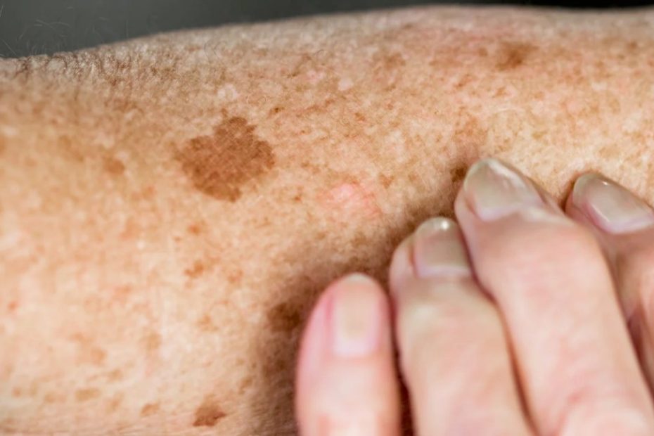 age-spots-causes-symptoms-and-treatment-richmond-hill-cosmetic-clinic