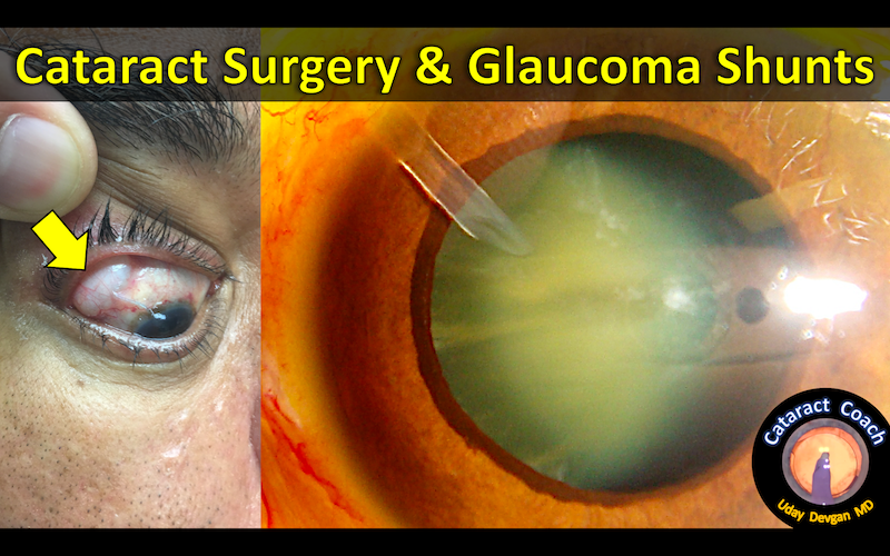Cataract Surgery With Glaucoma Shunts – Cataract Coach™